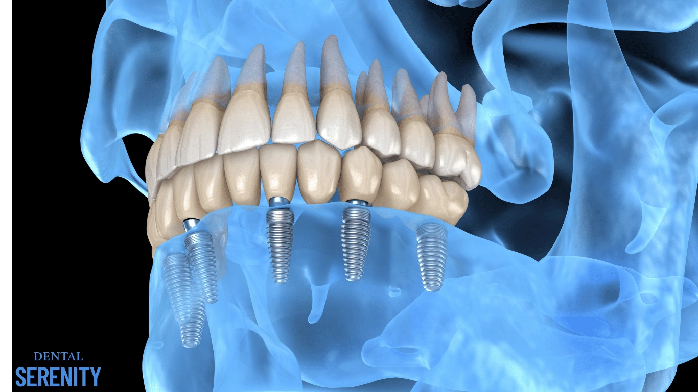 ALL-ON-6 IMPLANTS