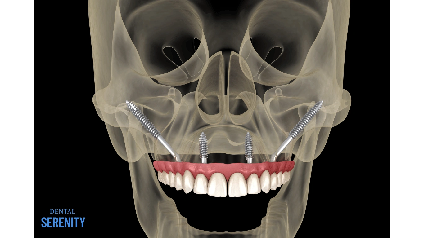 PTERYGOID IMPLANTS