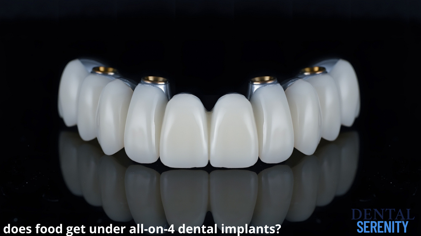 does food get under all-on-4 dental implants?
