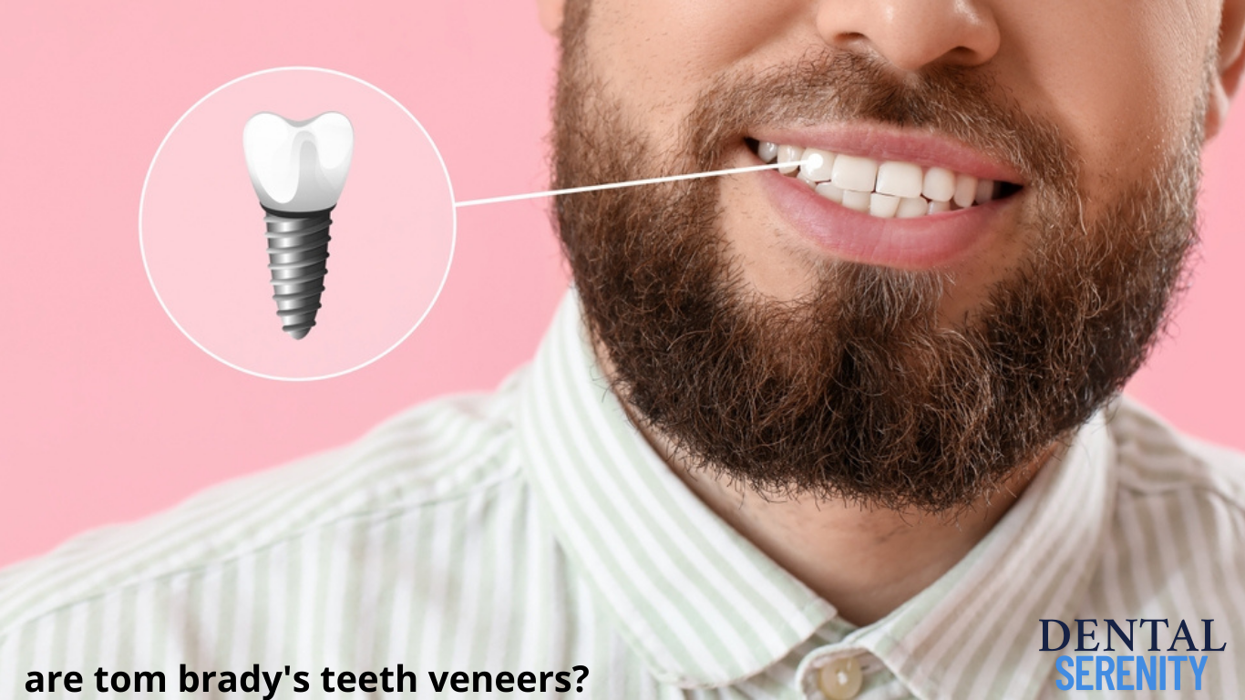 are tom brady's teeth veneers?