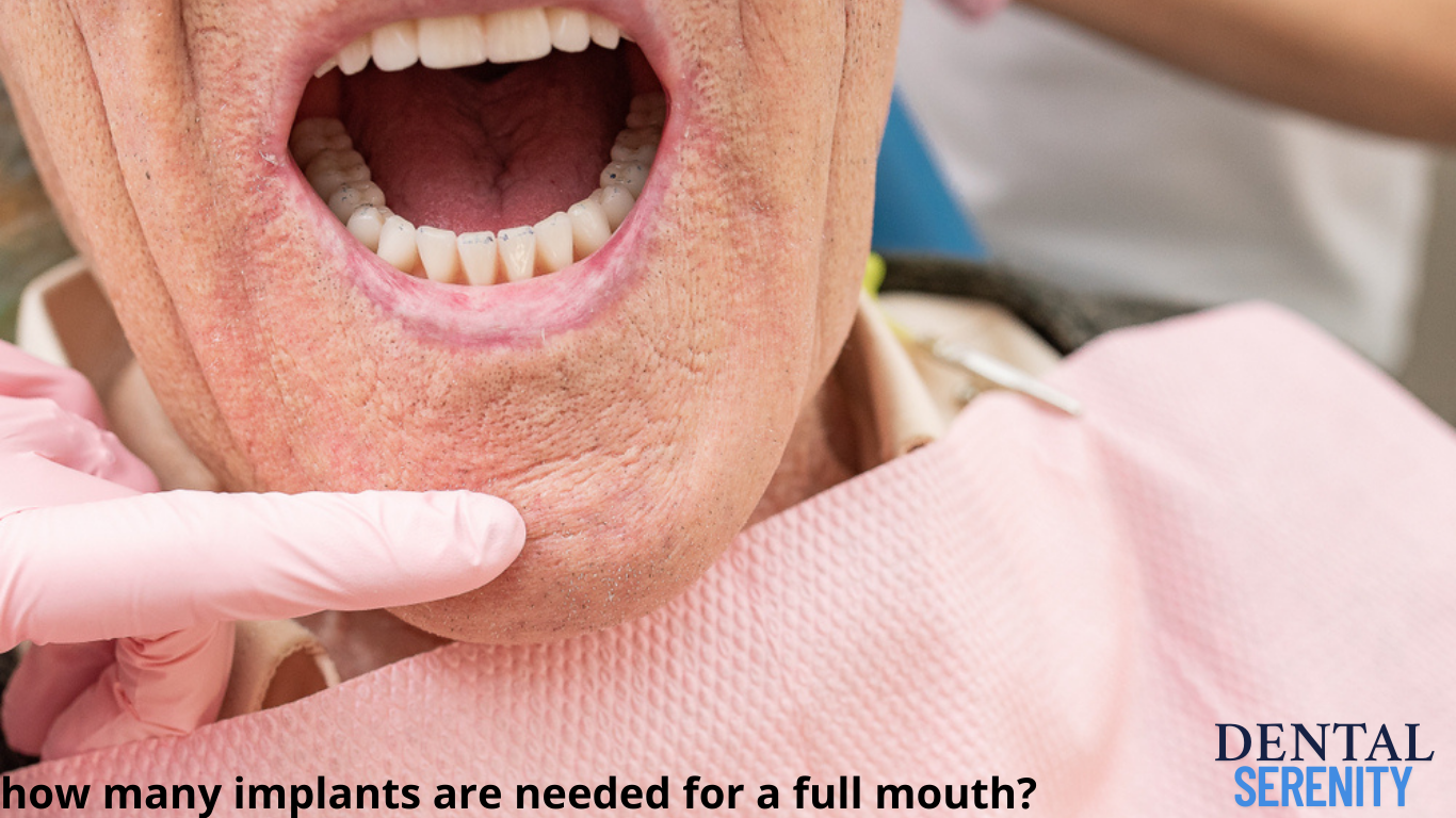how many implants are needed for a full mouth?